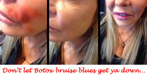 Khuraira Cosmetics Remove Botox Bruise Blues